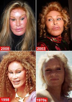 Scariest Picture, Botched Plastic Surgery, Plastic Surgery Procedures, Kate Jackson