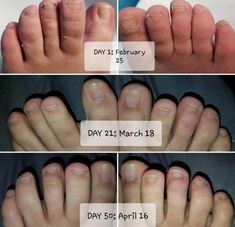 We won't tell anyone you secretly love these photos, don't worry. Fake Toenails Before And After, Pedicure Before And After, Dry Heels, Fake Toenails, Nail Infection, Love Or Hate, Nails Today, Nail Care Routine