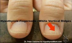 Do you have hypothyroidism? Look at your hands | Hypothyroid Mom White Lines On Nails, Nail Ridges, Nail Problems, Health Signs, Lines On Nails