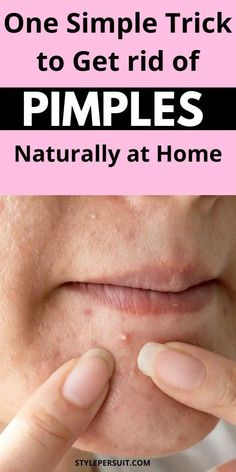 Pimple Remedies Overnight, Pimple Remedies, Pimples On Scalp, Face Pimples, Get Rid Of Pimples Overnight, Rid Of Pimples Overnight, Home Remedies For Pimples