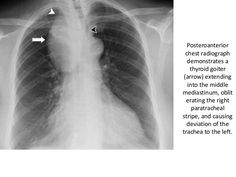 an x - ray shows the chest and ribs, with arrows pointing to the right