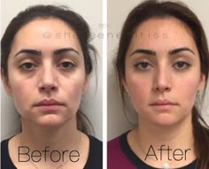 Cosmetic Injections, Botox Facial, Derma Fillers, Cosmetic Fillers, Under Eye Fillers, Face Fillers, Cheek Fillers, Cosmetic Injectables