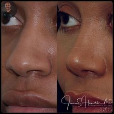 Mommy Makeover Surgery, Nose Fillers