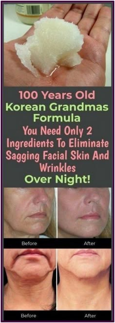 YOU NEED ONLY 2 INGREDIENTS TO ELIMINATE SAGGING FACIAL SKIN AND WRINKLES OVER NIGHT"" Facial Wrinkles, Skin Care Wrinkles, Over Night, Beauty Remedies, Skin Remedies, Beautiful Body, Sagging Skin, Anti Aging Skin Products, 2 Ingredients