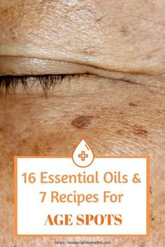 Age Spots Essential Oils, Essential Oils For Age Spots, Get Rid Of Age Spots, Age Spots On Face, Essential Oils For Face, Essential Oils Herbs, Essential Oils Health