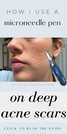 Microneedling for acne scars how to use a Microneedling pen Deep Acne Scar Removal, Pitted Acne Scar Removal, How To Fix Acne Scarring, Dermarolling Face, Microneedling Procedure, Face Acne Remedies, At Home Microneedling, Microneedling At Home