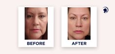 Facial Exercises For Jowls, Turkey Neck Exercises, Exercise Face, Sagging Jowls, Facial Yoga Exercises, Facial Exercise, Jawline Exercise, Face Yoga Method, Face Yoga Exercises