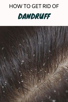 dandruff remedy What Causes Dandruff, Hair Problems Solutions, Best Anti Dandruff Shampoo, Treat Dandruff, How To Treat Dandruff, Shaving Tips, Top Treatments