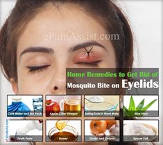 Mosquito Bite on the Eyelid may make it difficult for you to open or close the eyes and can make sleeping difficult for you. Babies tend to suffer most with Mosquito Bite on the Eyelids. Know the home remedies to get rid of mosquito bite on eyelid. Remedies For Mosquito Bites, Bug Bites Remedies, Insect Bite, Mosquito Bites, Beluga Whale, Mosquito Bite, Bug Bites, Stomach Ache, Insect Bites