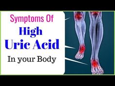 Acidic Body Symptoms, Uric Acid Diet Food, Low Uric Acid Diet, Uric Acid Remedy, Uric Acid Symptoms, Uric Acid Diet, Uric Acid Crystals, Uric Acid Levels, Uric Acid