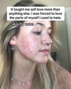 Thank you, acne 🤍. #adultacne #pcosacne #clearskin #glassskin #acnepositivity #acneneutrality Acne Awareness, August 15, Glass Skin, Clear Skin, Self Love, Acne, Thank You, On Instagram, Quick Saves