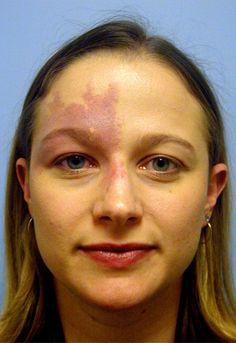 a woman with acne on her face, looking at the camera and to the side