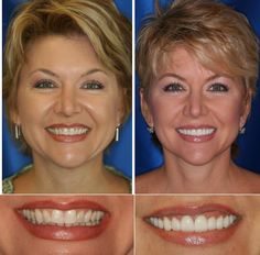 Porcelain Veneers Before And After, Teeth Remedies, Porcelain Crowns, Teeth Whitening Homemade, Veneers Teeth, Dental Work, Beautiful Teeth, Porcelain Veneers, Dental Veneers