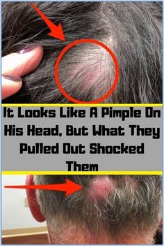 It looked like a pimple on his head, but what they pulled out shocked them.