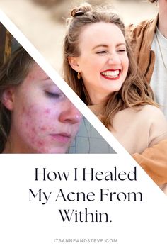 How I Cleared My Adult Cystic Acne Naturally By Trusting My Body Natural Remedies For Acne, Remedies For Acne, I Healed, Pimples Under The Skin, Natural Acne Remedies, Natural Acne, Skin Photo, Acne Causes, Hormonal Acne