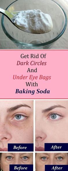 Eye bags: 1. Add 1 teaspoon of backing soda in a glass of hot water or tea and mix it well. 2. Take a pair of cotton pads and soak them in the solution and place them under the eye. 3. Let it sit for 10-15 minutes, then rinse it off and apply a moisturizer Practicing this procedure daily will render amazing results in just a week. Obličejové Masky, Remove Dark Circles, Under Eye Bags, Skin Remedies, Eye Bags, روتين العناية بالبشرة, Skin Tips