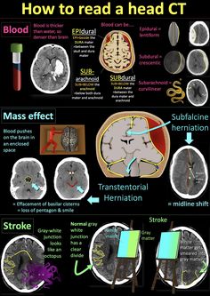 an image of how to read a head ct info poster with pictures and text on it