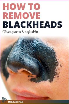 7 Amazing blackhead extraction remedies if you're struggling with blackheads or acne (nose and chin). I tried everything under the sun to clean my nose pores from annoying blackheads, and these worked the best. My skin is always soft, clean, and healthy. Diy Pore Strips, Nose Pores, Blackheads On Nose, Pore Strips, Home Remedy For Cough, Skin Natural Remedies, Cold Sores Remedies, Eye Exercises, Blackhead Removal