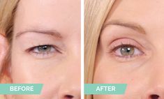 Contours Rx | Order Saggy Eyelids, Dry Eyelids, Hooded Eyelids, Droopy Eyelids, Droopy Eyes, Eyelid Lift, Beauty Technology, Eyebrow Makeup Tips, Upper Eyelid