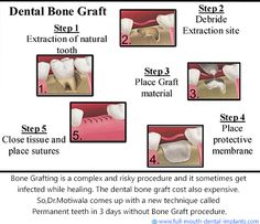 #Bone Grafting is a surgical system that replaces lacking bone to be able to restore bonefractures which are extremely complex, pose a big health hazard to the sufferer (or) fail to heal properly. #Dr.Motiwala comes up with a new technique called Permanent Teeth in 3 Days without Bone Grafting procedure. http://full-mouth-dental-implants.com/bonegrafting.php Dental Assistant School, Dental Animation, Dental Assistant Study, Pinterest Tutorials, Medical Animation, Front Teeth, Medical Jewelry