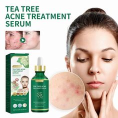 TeaTree Oil Serum, Acne Cure For Prone Face Sensitive Skin, Cystic Acne Pimples Scar Remover, Redness Relief, Niacinamide Facial Moisturizer 30ML Features: Acne Clearing Ability Increased by 15%Acne Cure Serum uses pure Australian teatree oil and more natural plant extracts such as Hamamelis Virginiana, rehmannia chinensis rationality, ginger, houttuynia cordata and so on; Accelerates cystic acne cure, pimples removal and redness repair, its perfect for acne-prone skin. Acne Prevention & Non-Irr Tea Tree For Acne, Cystic Acne Remedies, Acne Reduce, Tea Tree Oil For Acne, Forehead Acne, Scar Remover, Pimple Scars, Healing Tea, Natural Acne Remedies