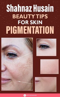 Asking For Too Much, Bueaty Tips, Tips For Skin, Eyeshadow Tips, Ashley Brown, Skin Pigmentation, Pimple Marks, Beauty Tips For Face, Skin Blemishes