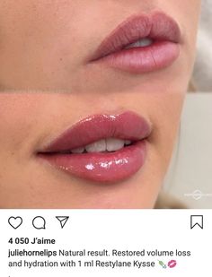 Upturned Lips Corners, Lip Filler Shape Ideas, Lip Filler Before And After, Restylane Lips, Thick Lips, Lips Aesthetic, Drawing Lips