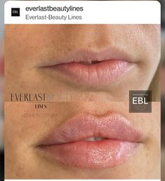 Lip Filler Before And After Small Lips, Natural Full Lip Filler, Lip Filler Before And After Side Profile, Lip Filler Before And After Small Mouth, Lip Filler Small Mouth, Juvederm Volbella Lips, Lip Fillers Before And After 1ml Small Lips, Lip Fillers Side Profile