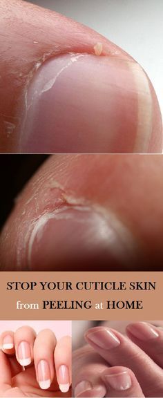 Peeling Cuticles, Peeling Nails, Tongue Health, Cuticle Care, Hand Care, Color Street, Diy Beauty, Beauty Care