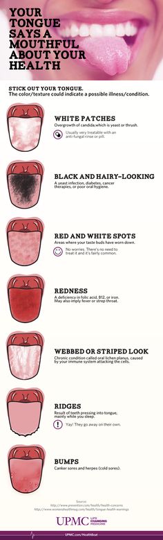 Next time you're in front of the mirror, check out your tongue - it can tell you a lot about your health! Health Infographic, Kedokteran Gigi, Tongue Health, Oil Pulling, Nail Health, Dental Hygiene, Oral Hygiene, Oral Health