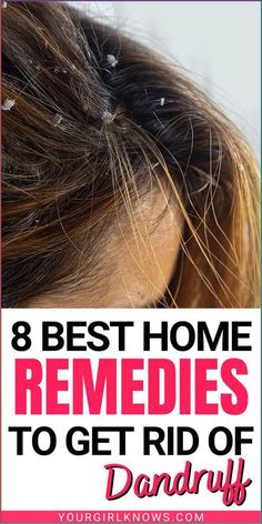 Natural Remedies For Dandruff, Short Haircuts For Oval Faces, Natural Dandruff Remedy, Clear Scalp, Haircuts For Oval Faces, Home Remedies For Dandruff, Dandruff Solutions, Home Remedies For Allergies, Home Remedies For Warts