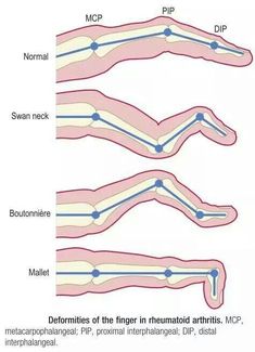 Rheumatoid Arthritis: Swan neck deformity vs boutonniere deformity Deformities of the finger in Rheumatoid arthritis (RA) Symptoms of arthritis in the hands may include Occupational Therapy Hand Therapy, Nbcot Exam, Ra Symptoms, Physical Therapy School, Physical Therapy Student, Physical Therapist Assistant, Occupational Therapy Assistant, Medical Student Study