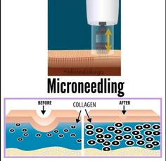 Microneedling Skinpen, Skinpen Microneedling, Benefits Of Microneedling, Dermapen Microneedling, Esthetician Quotes, Skin Needling, Skin Care Pictures, Bb Glow