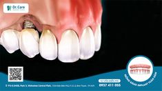 Trồng răng Implant giá rẻ, không chính hãng hoàn toàn không giúp bệnh nhân tiết kiệm chi phí mà còn rất dễ gây ra các biến chứng sau khi cấy ghép, nghiêm trọng nhất là đào thải trụ Implant. Central Park, Convenience Store Products