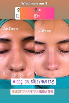 Rhinoplasty Bulbous Nose, Bulbous Nose Job Before And After, Thick Skin Bulbous Tip Rhinoplasty, Thick Nose Rhinoplasty, Nose Job Thick Skin, Thick Skin Nose Job, Nose Job Before And After Bulbous, Thick Skin Rhinoplasty