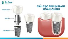 Nhiều Cô Chú, Anh Chị muốn trồng răng Implant nhưng vẫn chưa biết nên trồng răng Implant loại nào. Hãy cùng Dr. Care tìm hiểu nhé.