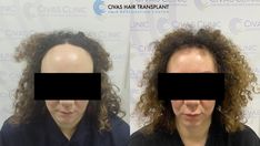 Procedure: FUE Hair Transplant
Session: 1
Graft Number: 1642 Grafts
Results: 12 Months Post-Op results

Transforming Lives, ONE Hair Transplant A Day

Civas Hair Transplant  is a clinic where excellence meets expertise in hair restoration. As one of the best hair restoration centers in Turkey, we take pride in delivering natural-looking results that redefine confidence. Our clinic is helmed by two distinguished dermatologists, each specializing in hair loss treatments. With accreditations from ISHRS, ABHRS, and IAHRS, we uphold the highest standards of care and professionalism.

FOR A FREE CONSULTATION AND QUOTATION, CONTACT US:

Website: https://www.civashairtransplant.com
Email: info@civashairtransplant.com
Whatsapp: +90 546 437 07 38