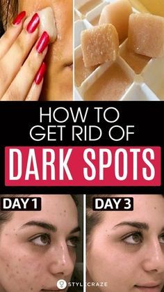 Black Spots On Face, Brown Age Spots, Brown Spots On Skin, Acne Dark Spots, Dark Spots On Face, Brown Spots On Face, Dark Spots On Skin