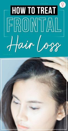 Frontal hair loss or receding hairline is the earliest sign of hair loss. This article discusses what causes it and how to slow down the process of hair loss. Forehead Hair, Frontal Hair, Loss Hair, Brown Spots On Face, Hair Growth Supplement, Regrow Hair, Home Remedies For Hair, Hair Remedies, Skin Diseases