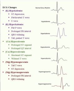 Sinus Rhythm, Ekg Interpretation, Normal Sinus Rhythm, Pr Interval, P Wave, Family Nurse Practitioner, Nursing School Humor, Nursing School Survival