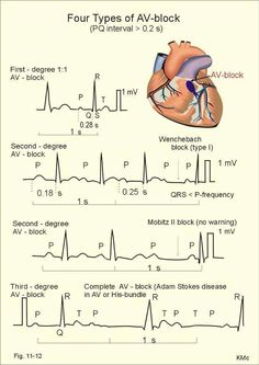 Heart blocks Ekg Interpretation, Paramedic School, Nursing Mnemonics, Cardiac Nursing, Heart Blocks, Nursing School Survival, Critical Care Nursing, Nursing School Studying