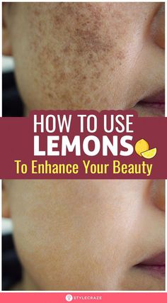 Lemon is an effective ingredient that offers a myriad of benefits not just in the kitchen but also outside it. It is a disinfectant, an astringent, Lemon Juice For Skin, Lemon On Face, Lemon Face Mask, Forehead Acne, Brown Spots On Skin, Lemon Uses, Brown Spots Removal, Homemade Mask, Brown Spots On Face