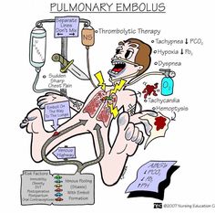 an image of a cartoon character with the words, fulmiary embolus