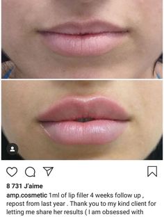 Different Styles Of Lip Filler, Hollywood Lips Filler, Lip Filler Shape Ideas Pouty, Lip Filler Shape Ideas 1ml, Lip Fillers Before And After 1ml Russian, Keyhole Pout Lips, Lip Filler 1 Syringe, Lips Before And After Injections, Lip Injections Shapes