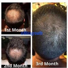 Hair Growth Oil Serum Hair Loss Treatment for Men or Women | Etsy Hair Growth For Men, Hair Growth Secrets, Vitamins For Hair Growth, Hair Remedies For Growth, Monat Hair, Hair Growth Faster, Hair Solutions, Hair Growth Tips, Hair Regrowth