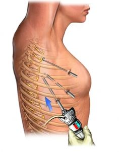 Thoracic Endometriosis on lungs & more. Varicose Vein Removal, Crps Awareness, Homemade Facial Mask, Support Groups, Healthy Benefits, Healthy Routine, Lungs