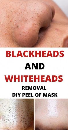 Blackheads And Whiteheads Removal, Diy Peel Off Mask, Whiteheads Removal, Blackheads And Whiteheads, Home Remedies For Pimples, Rid Of Blackheads, Pimples Remedies, Face Mapping, Cold Sores Remedies