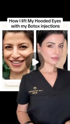 Botox Injection Patterns, Botox Parties Ideas Food, Botox Injection Sites Eyebrow Lift, Botox Locations On Face, Botox In Chin, Botox Jelly Roll Before And After, Nose Tip Lift Botox Before And After, Botox Eye Lift, Botox Crows Feet Eye