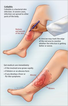 an illustration shows the stages of varicosis and how to treat it for them