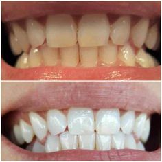 Snow's professional at-home teeth whitening system. Snow Teeth Whitening, Coconut Oil Teeth Whitening, Tooth Extraction Healing, Sensitive Teeth Remedy, Teeth Whitening Homemade, Teeth Whitening Remedies, Teeth Whitening Toothpaste, Teeth Whitening System, Pasta Dental